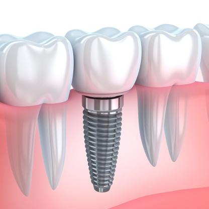 Der Weg zum neuen Zahn: Schritt-für-Schritt-Ablauf für Zahnimplantate